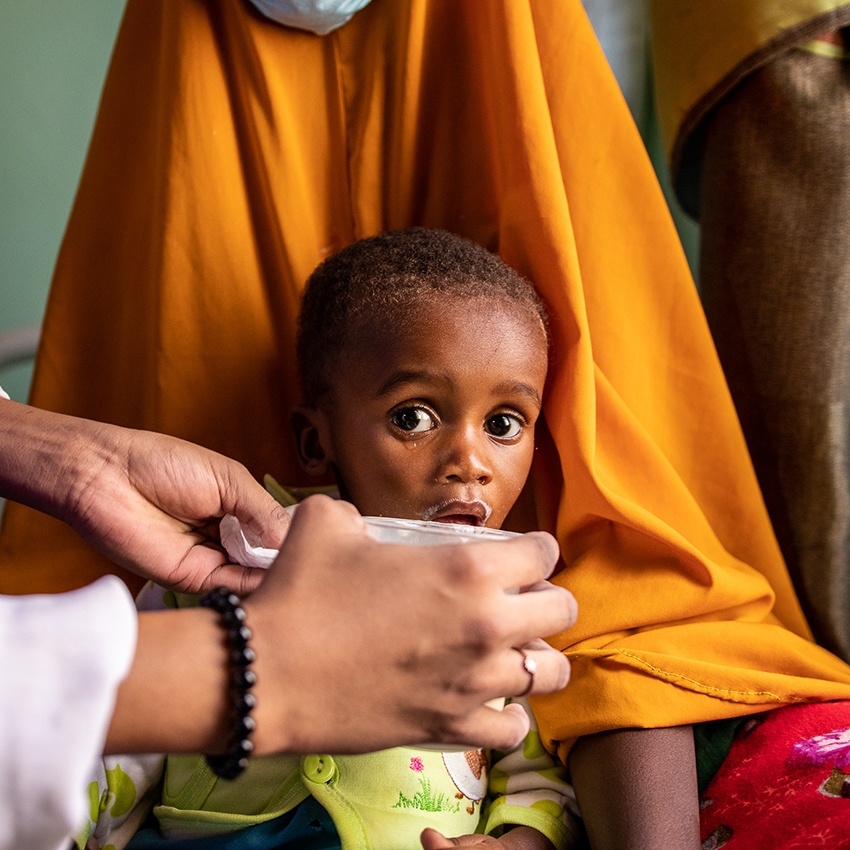 In Somalia, a baby receives treatment for malnutrition.