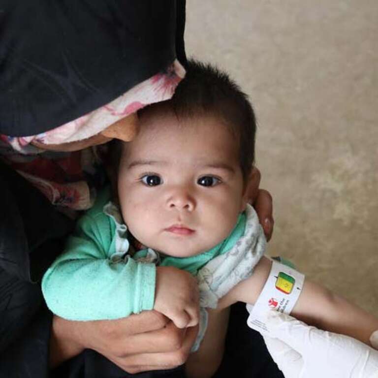 In Afghanistan, a baby suffering from severe acute malnutrition rests in the arms of a woman.