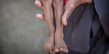 A mother holds the legs of her 13-month-old child who is severely malnourished. The baby was treated for malnutrition in a Save the Children supported clinic. After his treatment ended, he and his family got displaced as conflict in their neighborhood escalated and it wasn’t safe to live there anymore. Photo credit: Mohammed Awadh / Save the Children, Oct 2018.