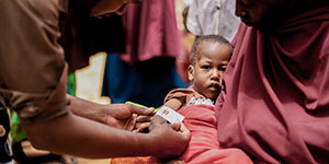  Feirusa was diagnosed with severe malnutrition. An aid worker puts a MUAC tape around her arm. 