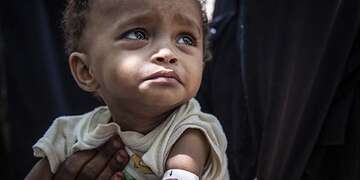 Malnutrition in Yemen.