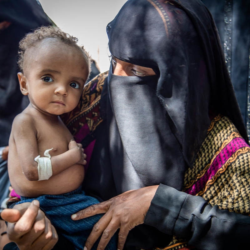 Daoud*, 15 months, at Save the Children’s Outpatient Therapeutic Programme (OTP), in a camp for Internally Displaced People (IDP), Lahj district, Yemen. Daoud* and his family were displaced from Hodeidah, Yemen. Photo credit: Jonathan Hyams / Save the Children 2018.