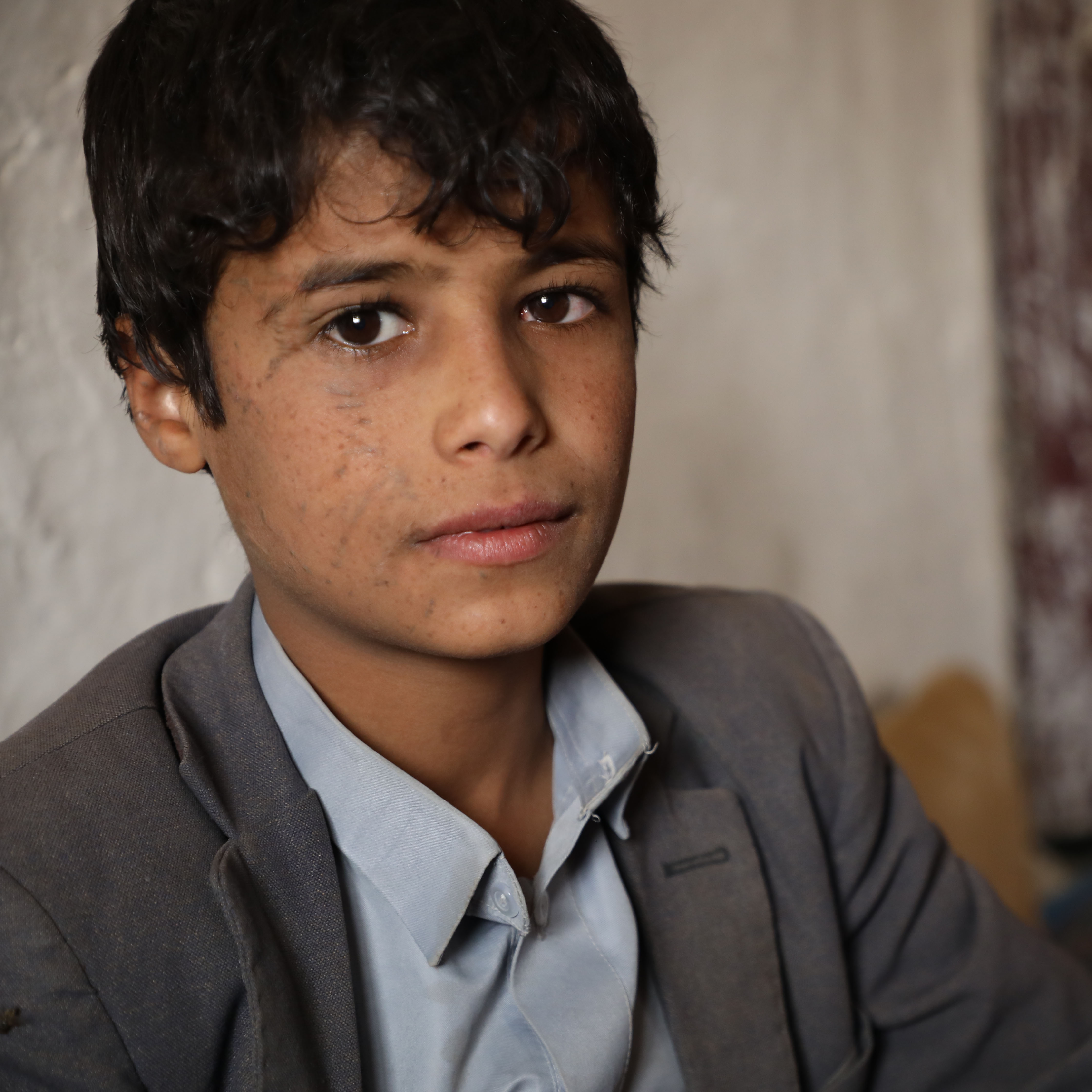 Musa*, was severely injured in his eye from an airstrike which targeted his school bus in Yemen.